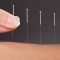acupuncture aliexpress