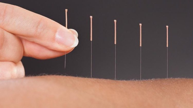acupuncture aliexpress